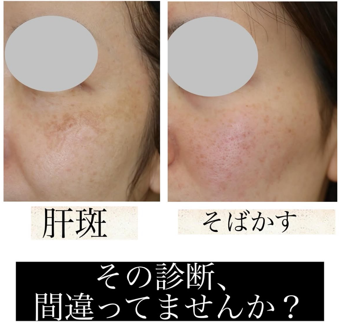 肝斑とシミの見分け方｜正確な診断が美肌治療の第一歩 | 咲くらクリニック